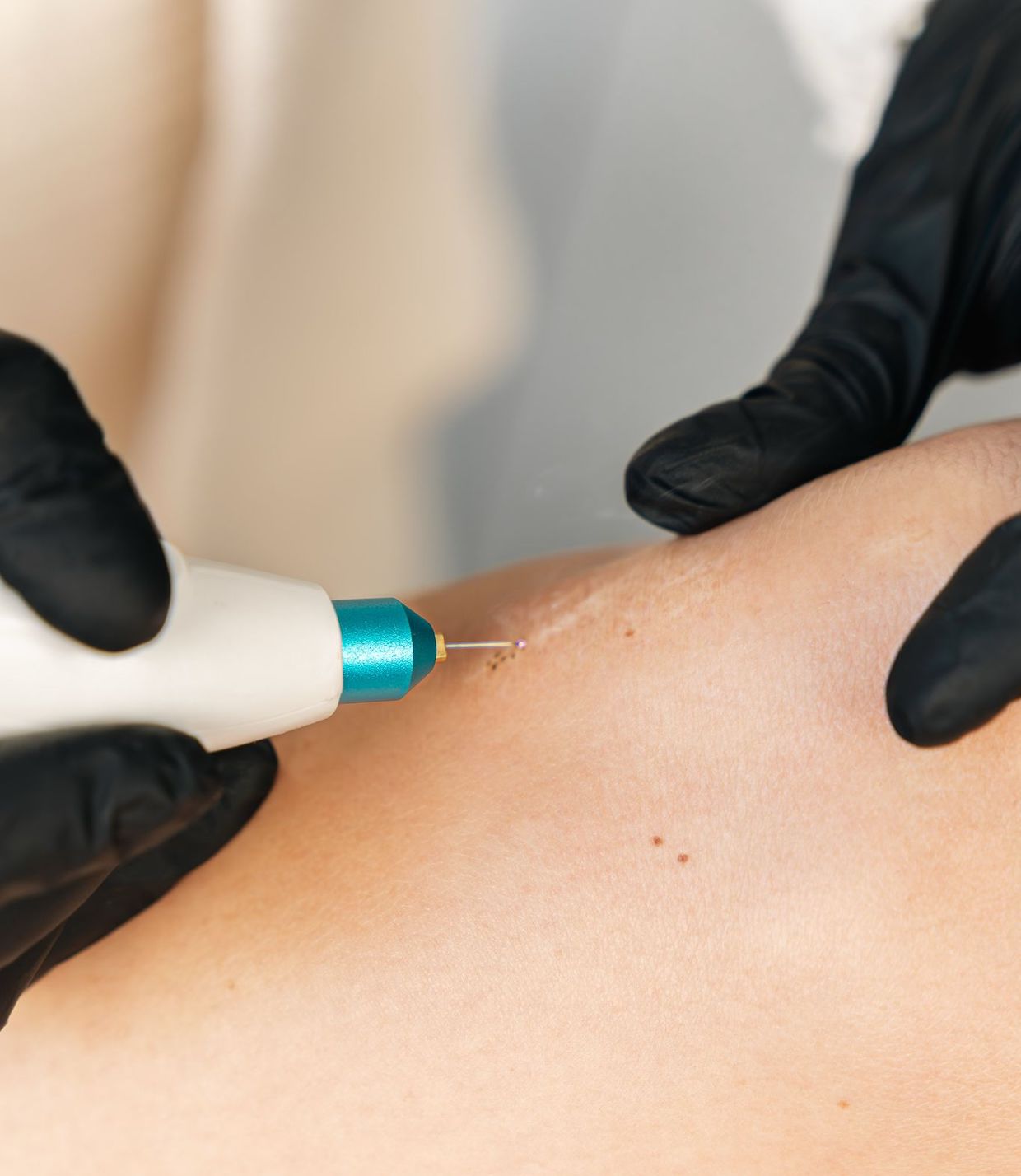photo de la formation plasma lift