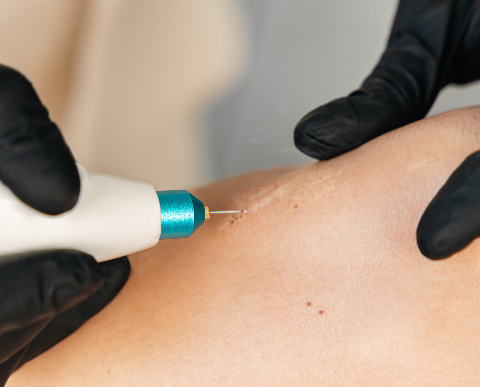 photo du soin plasma lift