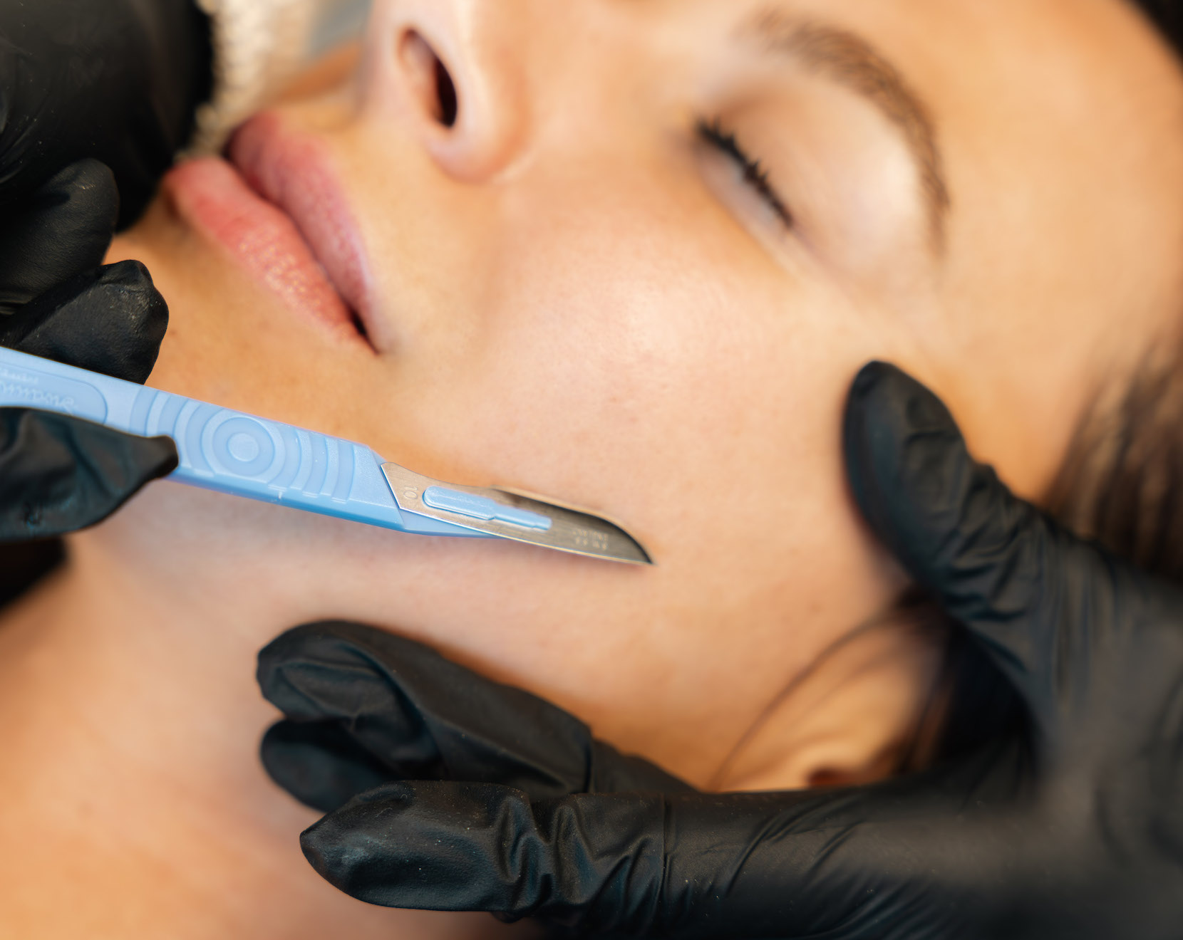 photo du soin dermaplaning