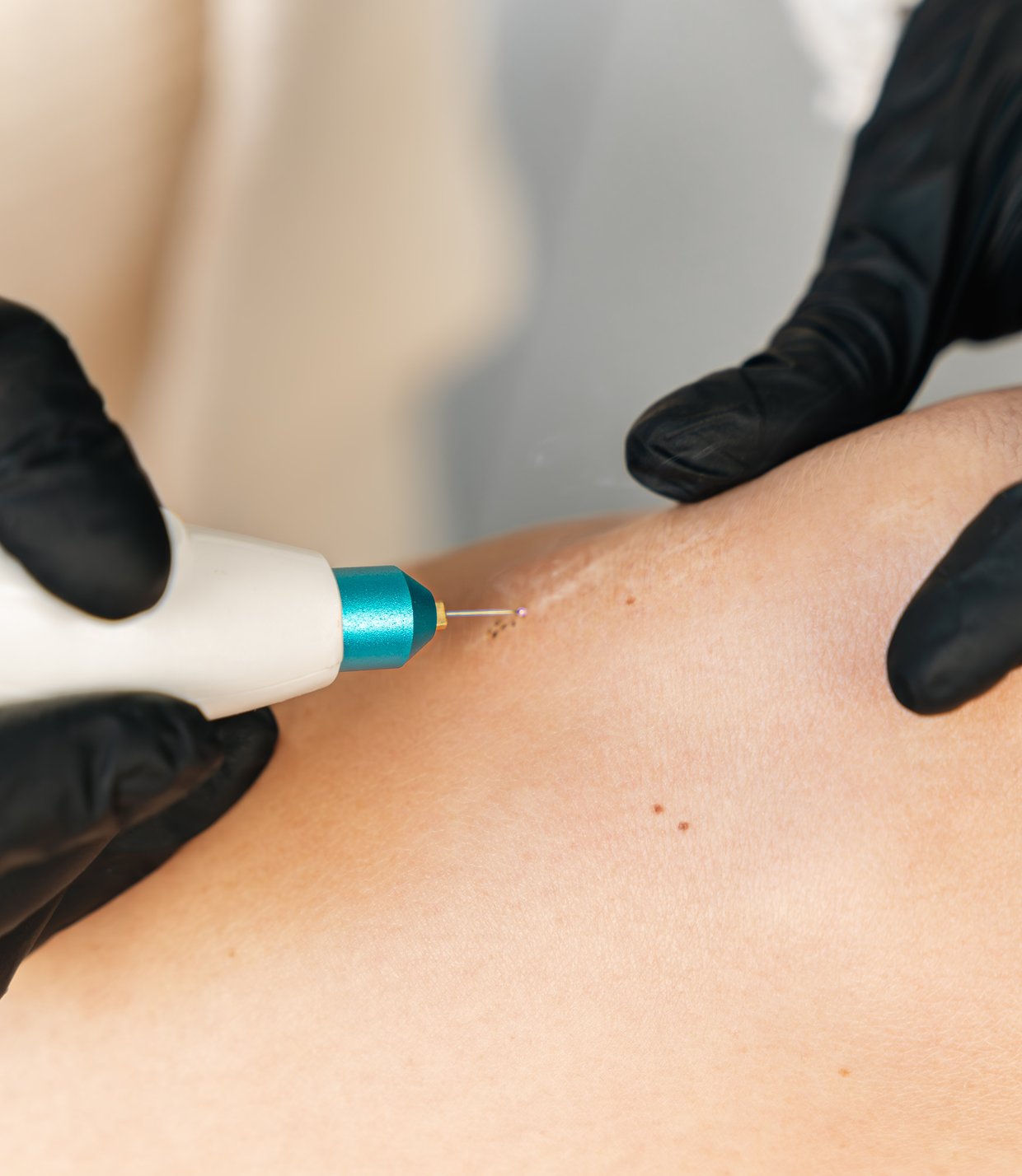 plasma lift